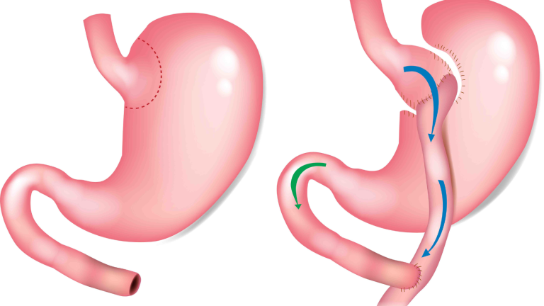 Bypass Gástrico: Tratamiento Integral para la Obesidad y la Diabetes