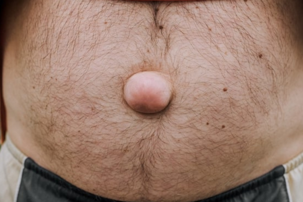 Hernia Abdominal