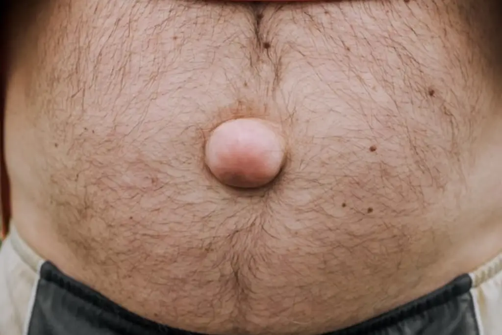 Hernia Abdominal