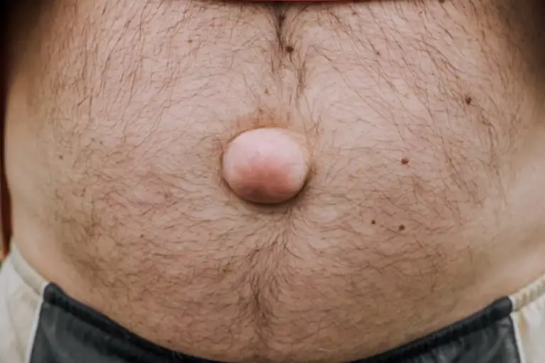Hernia Abdominal